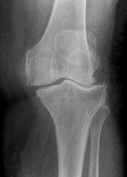 Gonarthrose